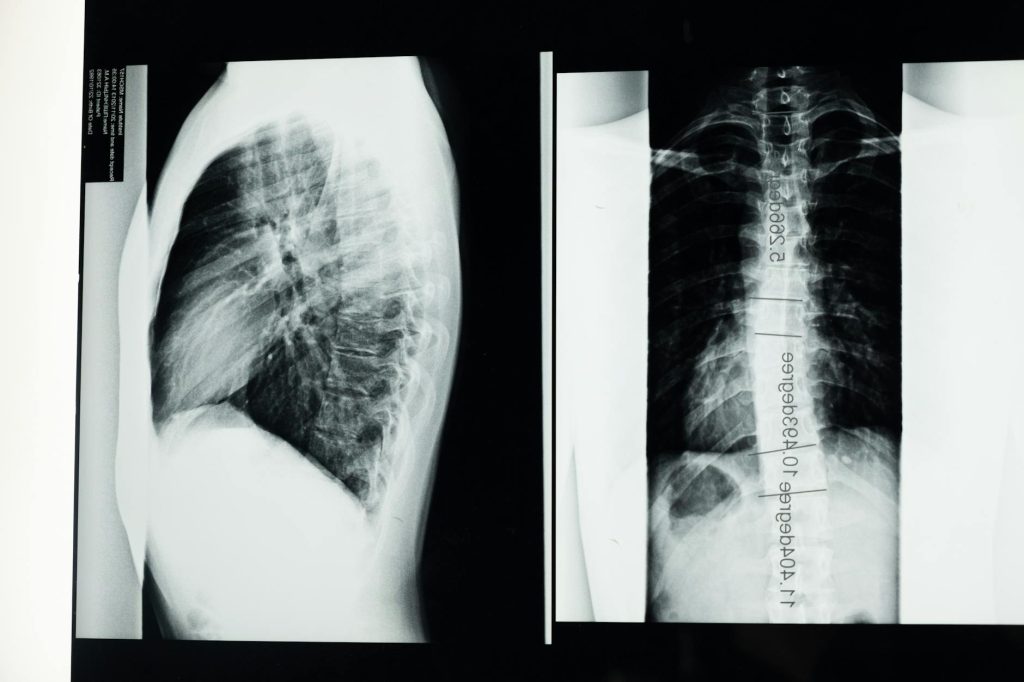Spine Surgery Quality Standards