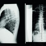 Spine Surgery Quality Standards