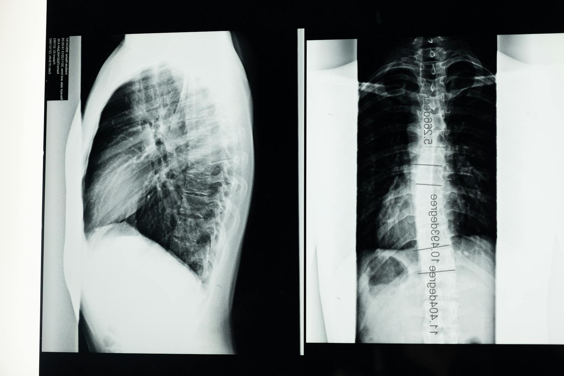 Spine Surgery Quality Standards